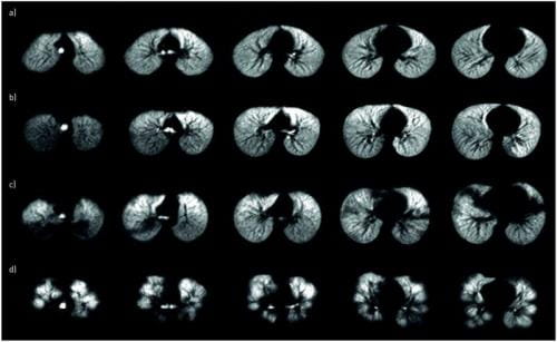 Representative axial xenon-129 (129Xe) ventilation magnetic resonance images from four haematopoietic stem cell transplantation (HSCT) patients.